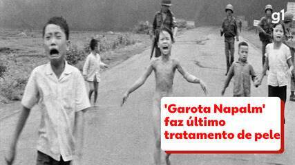 Garota da foto na Guerra do Vietnã passa por último tratamento de pele depois de 50 anos Garota da foto na Guerra do Vietnã passa por último tratamento de pele depois de 50 anos