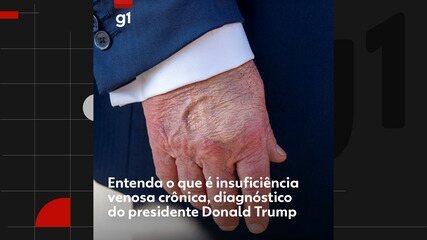 Entenda o que é insuficiência venosa crônica, diagnóstico do presidente Donald Trump Entenda o que é insuficiência venosa crônica, diagnóstico do presidente Donald Trump