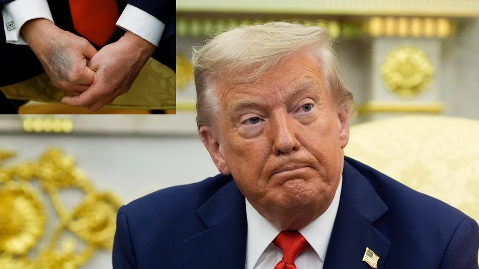 Mão do presidente Trump com hematoma em agosto — Foto: Reuters e AP