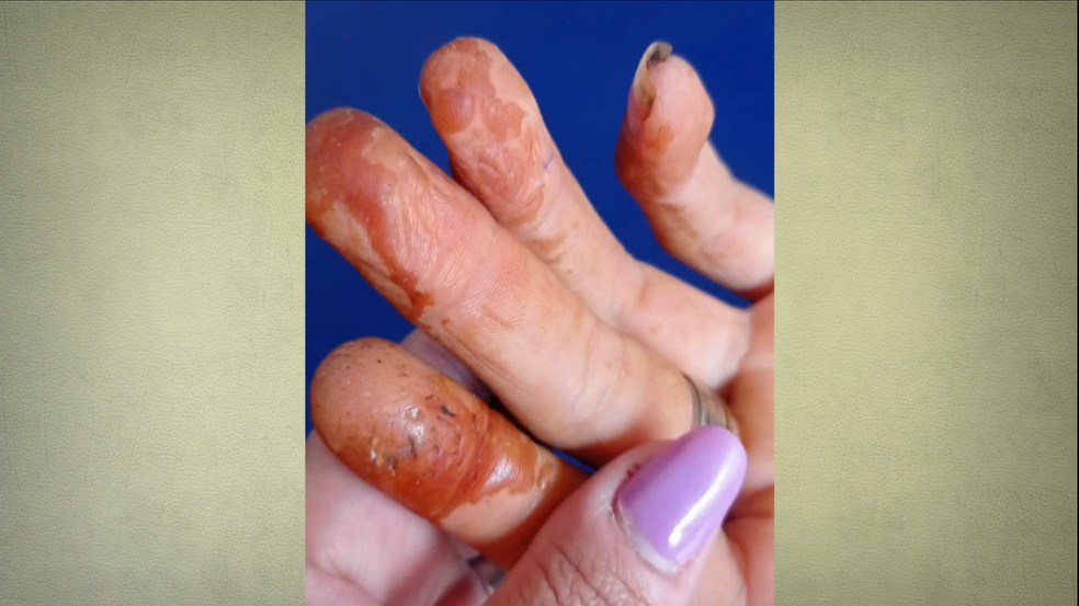 Mão de criança machucada pelo trabalho com a castanha de caju no Rio Grande do Norte — Foto: Reprodução / Globo Rural